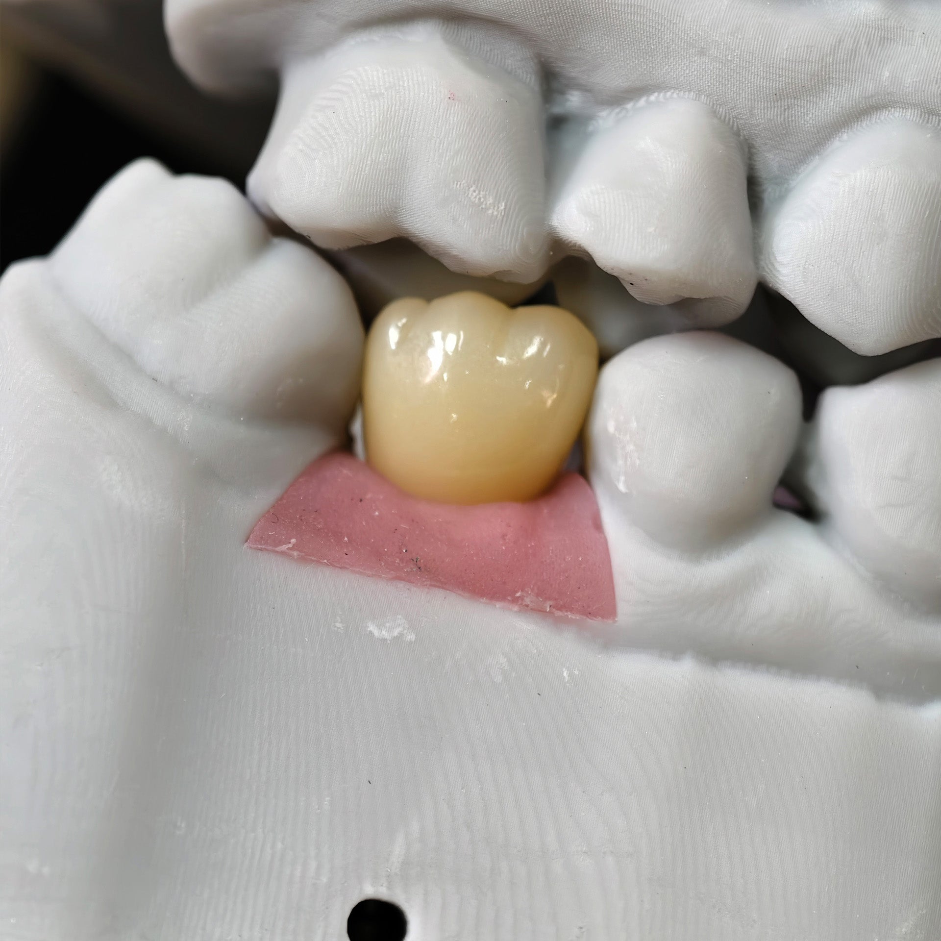 Zirconia Implant Crown With Gold Plating