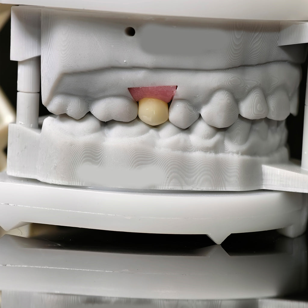 Zirconia Implant Crown With Gold Plating