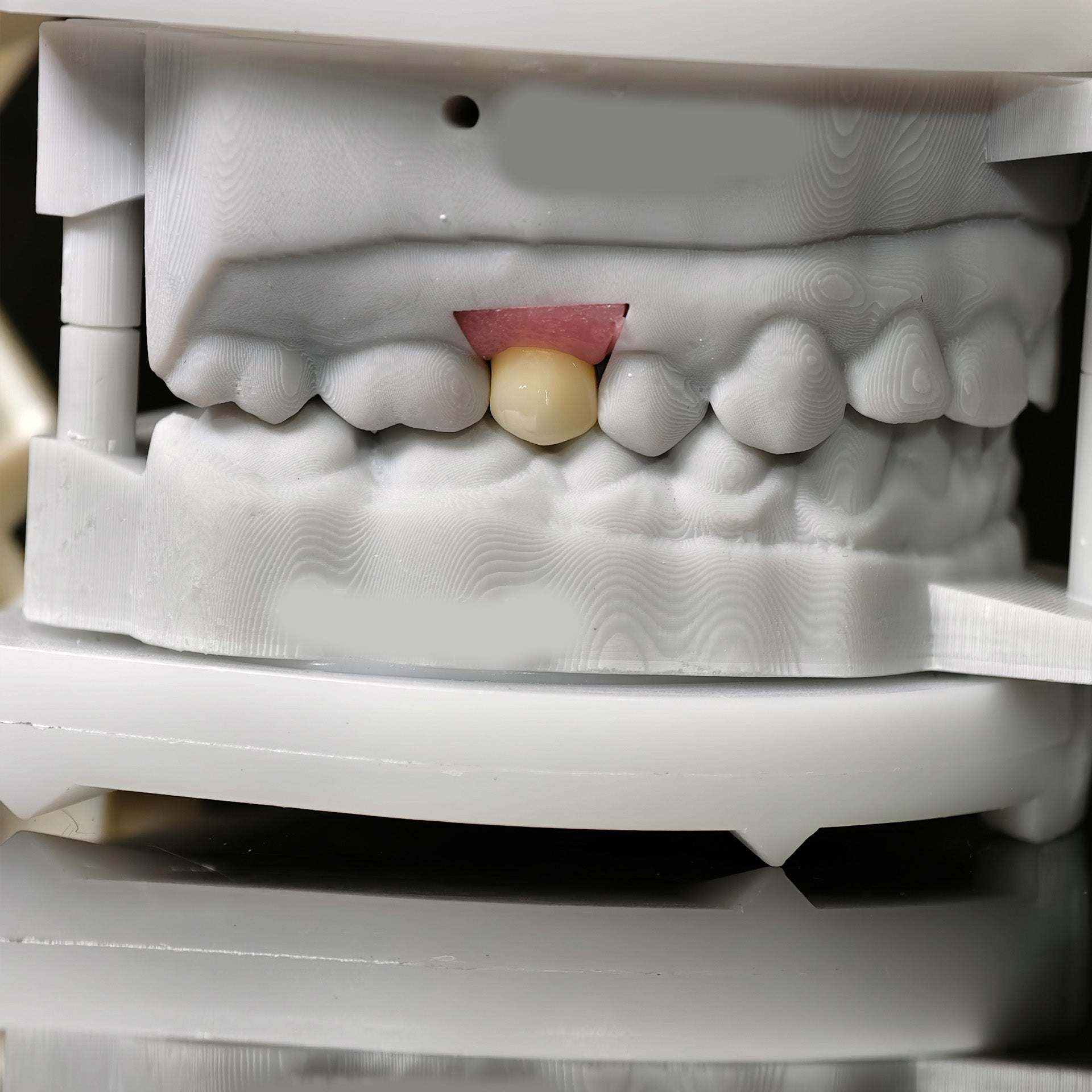Zirconia Implant Crown With Gold Plating