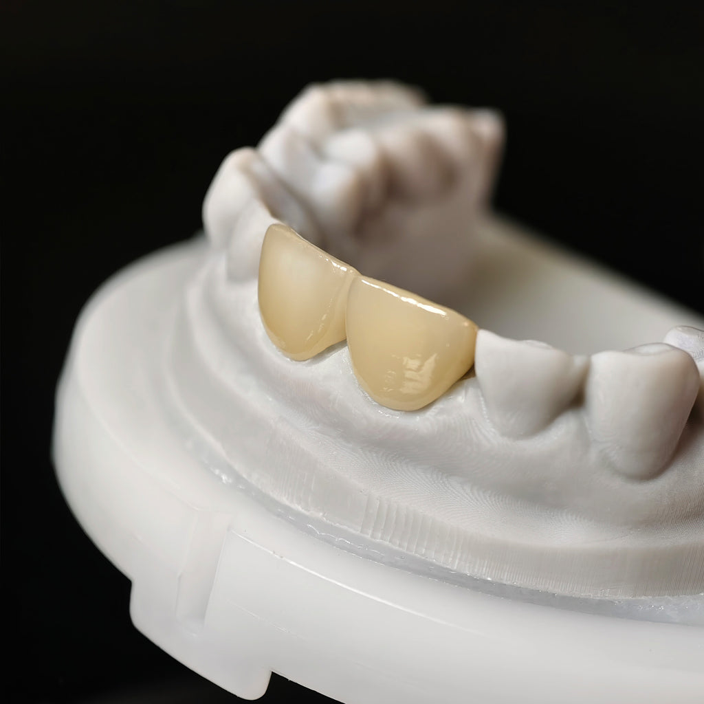 Zirconia Veneer. High Transparency/Translucent, Natural Shade
