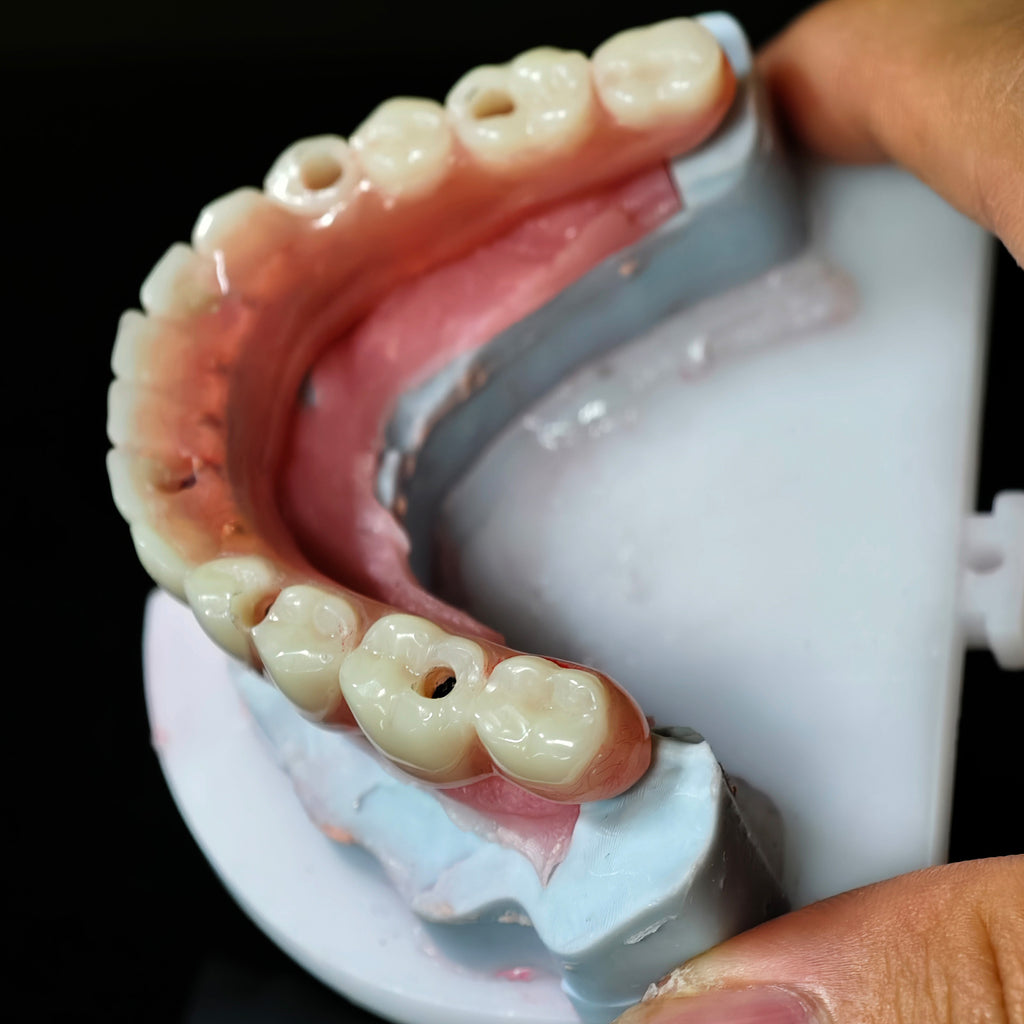 Acrylic Denture With Screw Retained