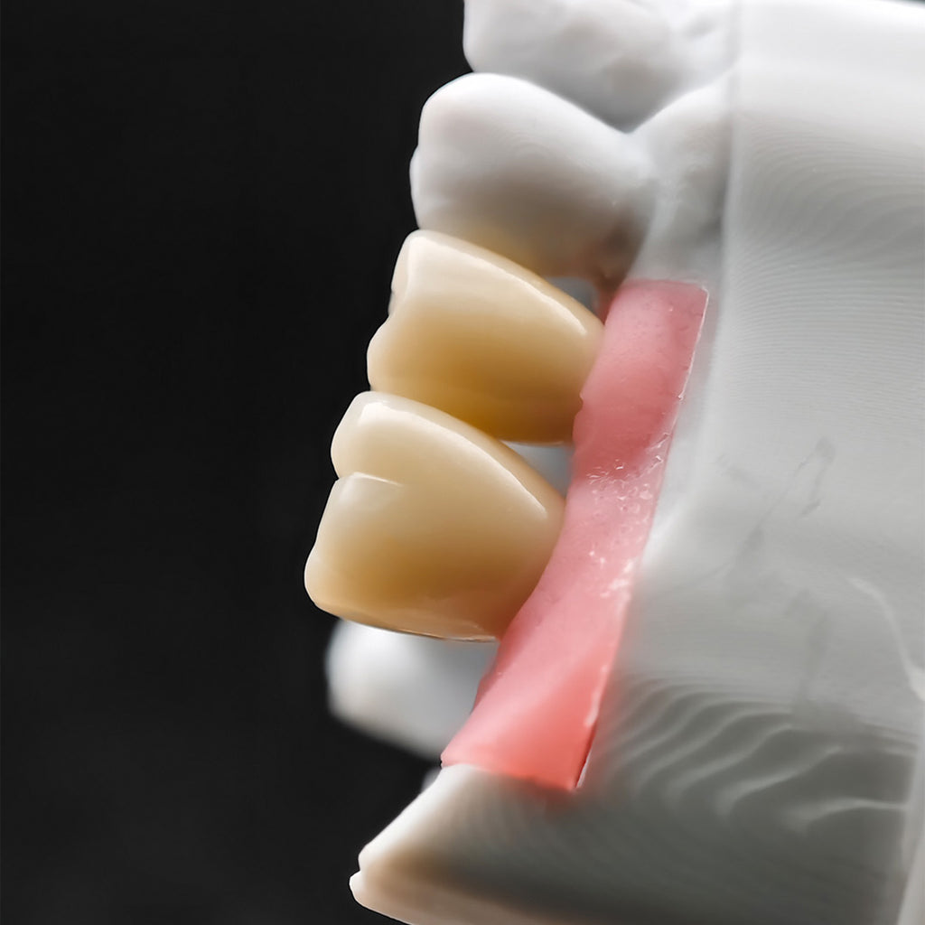 Custom Zirconia Implant Crowns
