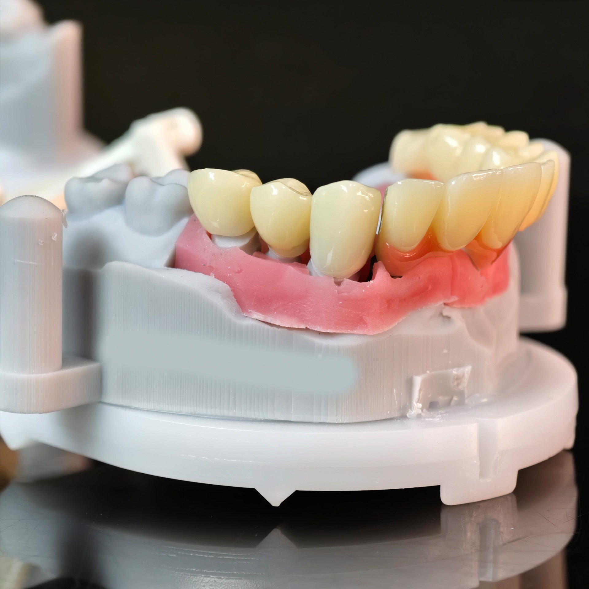 Custom Abutment And PMMA Bridge And Crown With Cement Retained