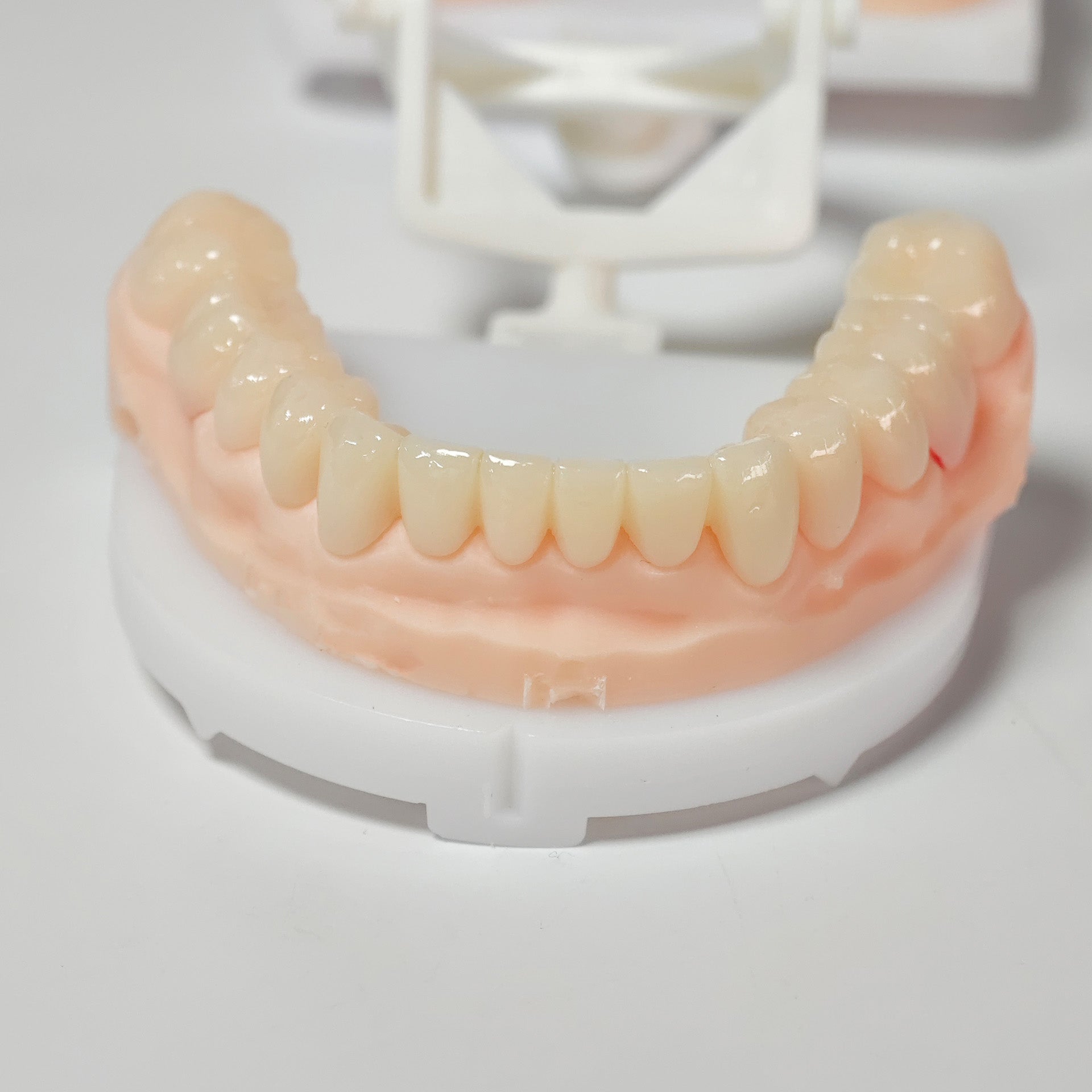 Full-Mouth Segmented PMMA Bridge With Cement Retained