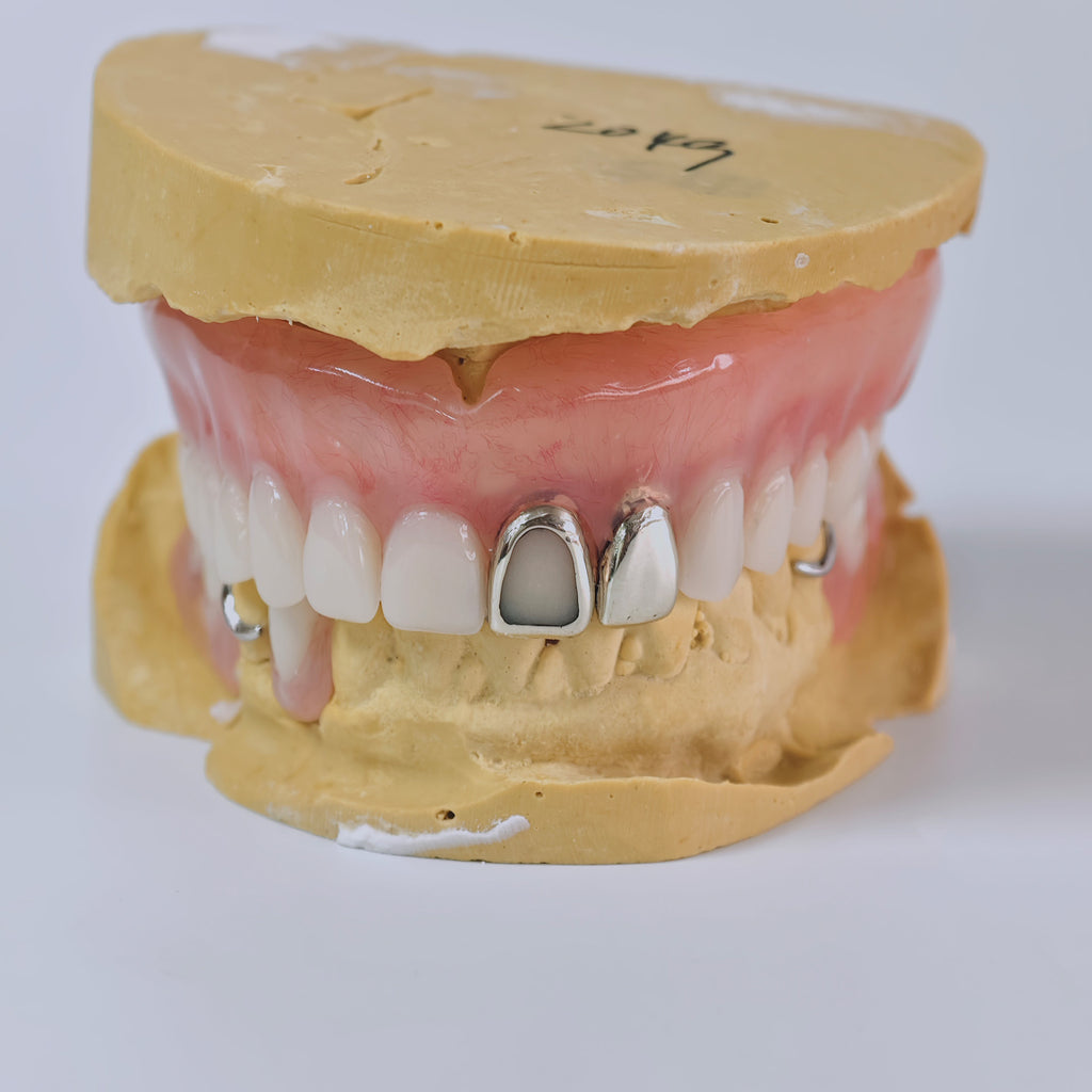 Full-Mouth Acrylic Denture