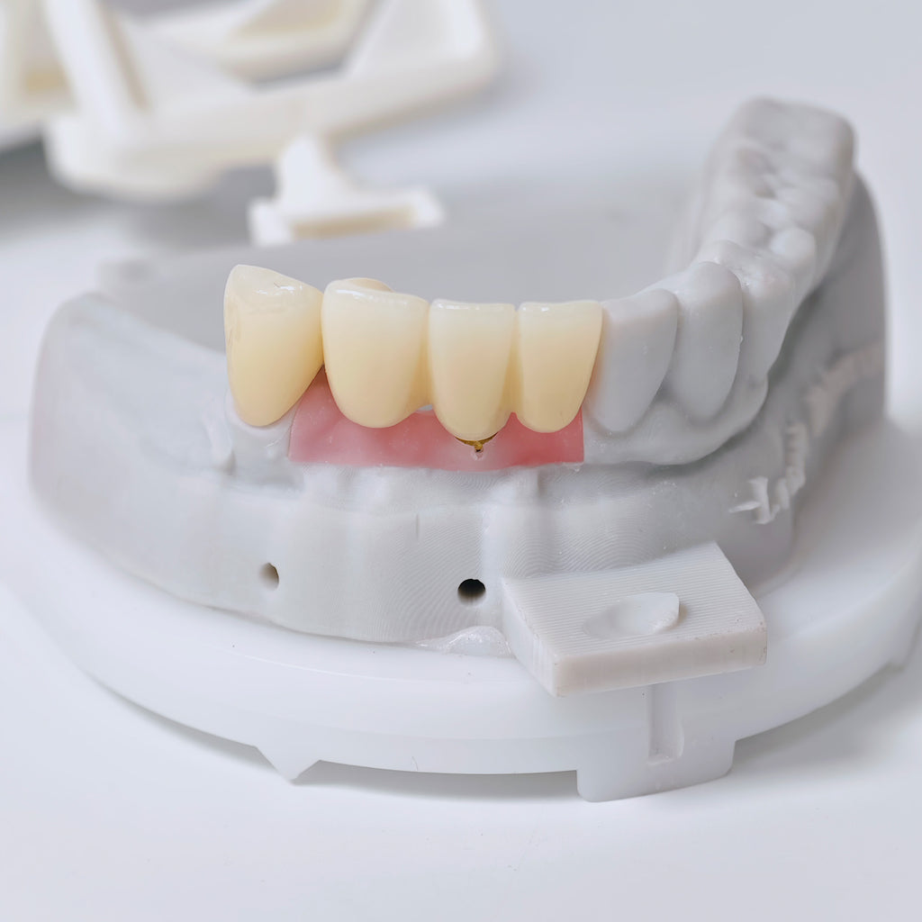 Full-Zirconia Crown And Bridge With Cement Retained And Co-Cr Frame Partial Denture