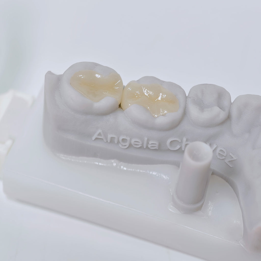 Full-Zirconia Laying With Cement-Retained