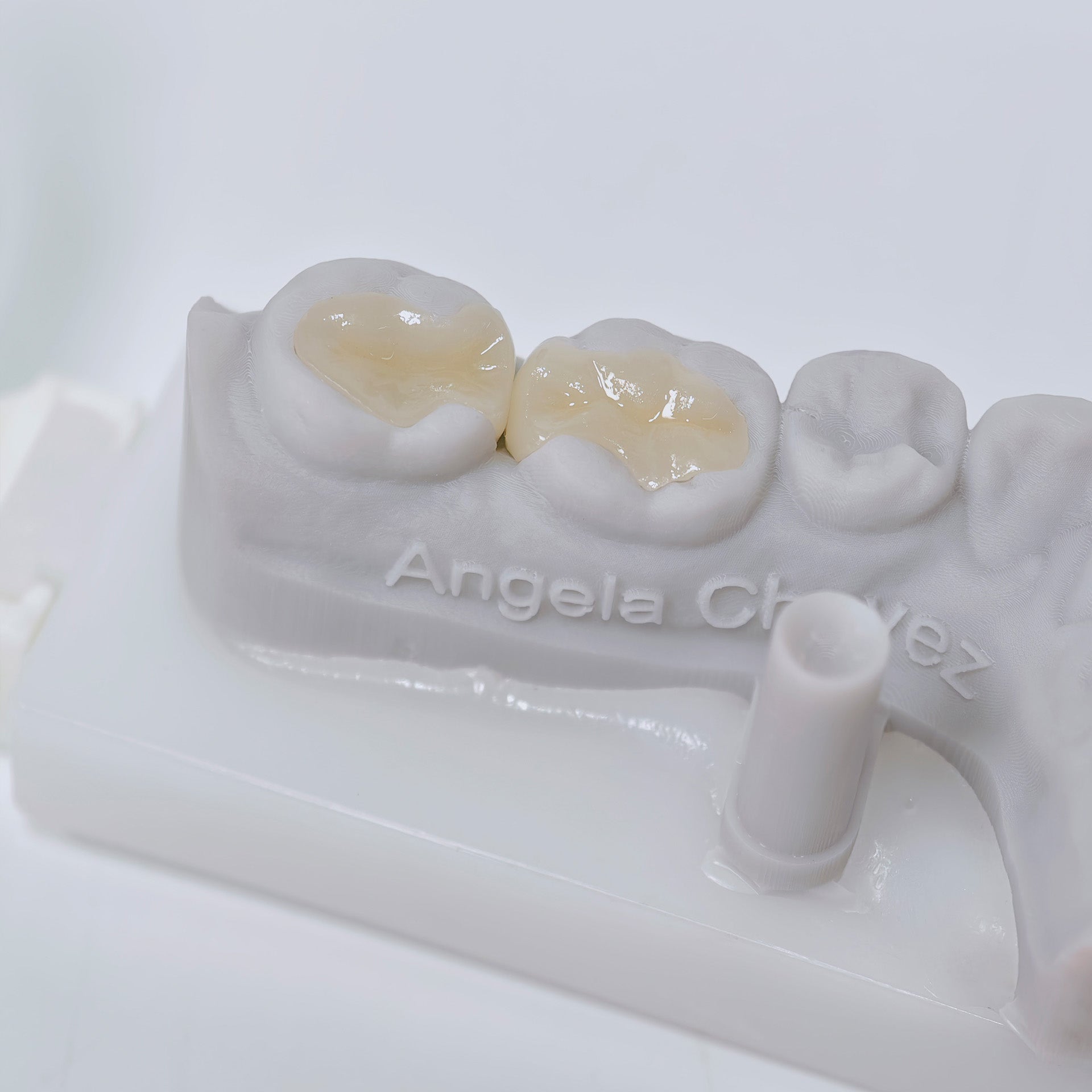Full-Zirconia Laying With Cement-Retained