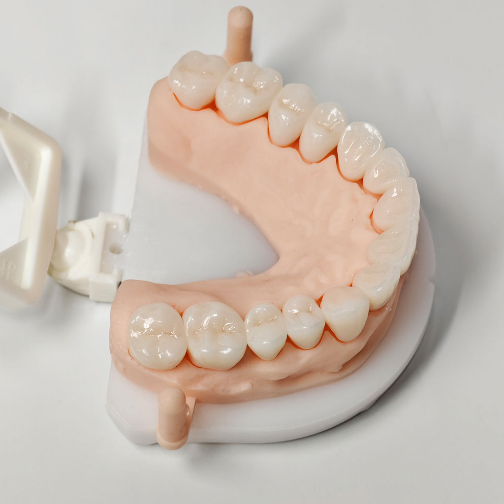 Full-Zriconia Crowns With Cement-Retained