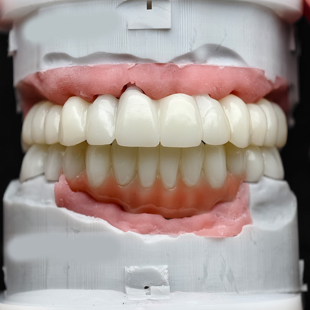 Pmma Bridge With Implant Seating Guide And Cemented