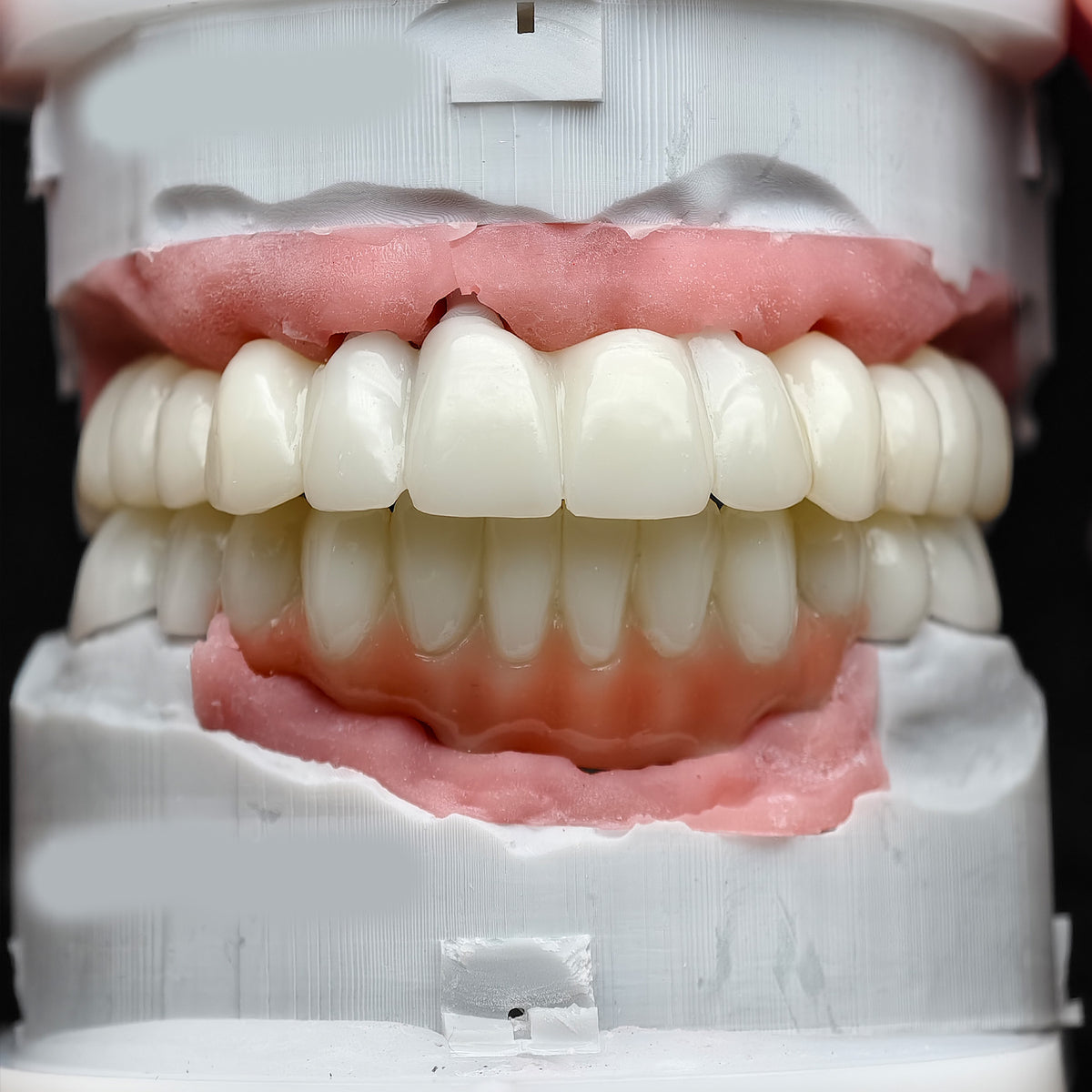 Pmma Bridge With Implant Seating Guide And Cemented