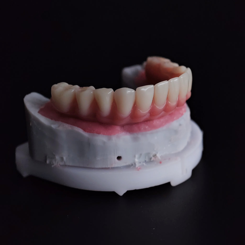 An Acrylic Denture With A Titanium Bar (Ti-Bar) Cost-Effective Full Arch Restoration Screw Retained