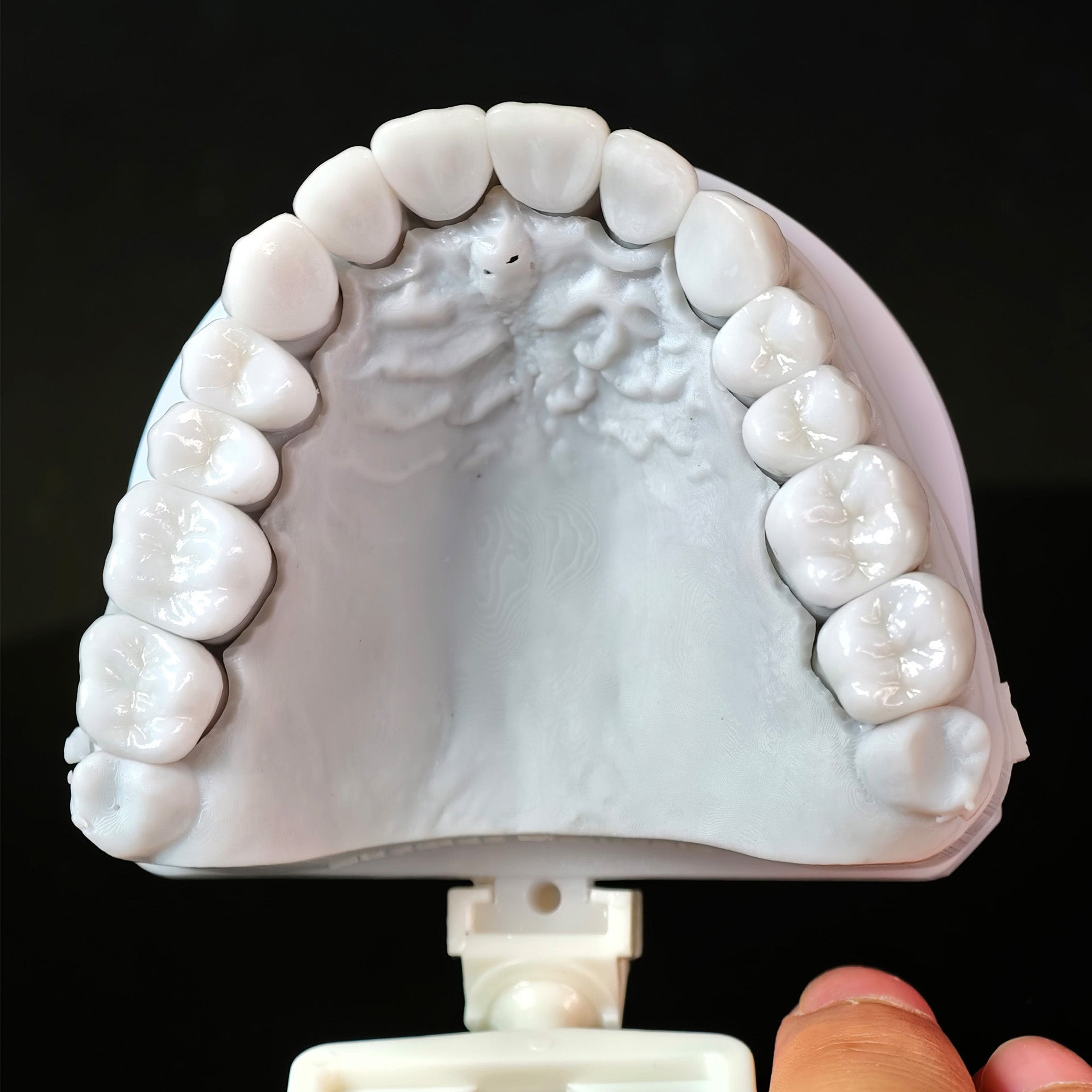 Ceramic Veneers And Crown With Cement Retained