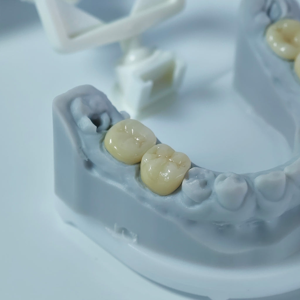 Co - Cr PFM Dental Crowns With Metal Post-And-Core