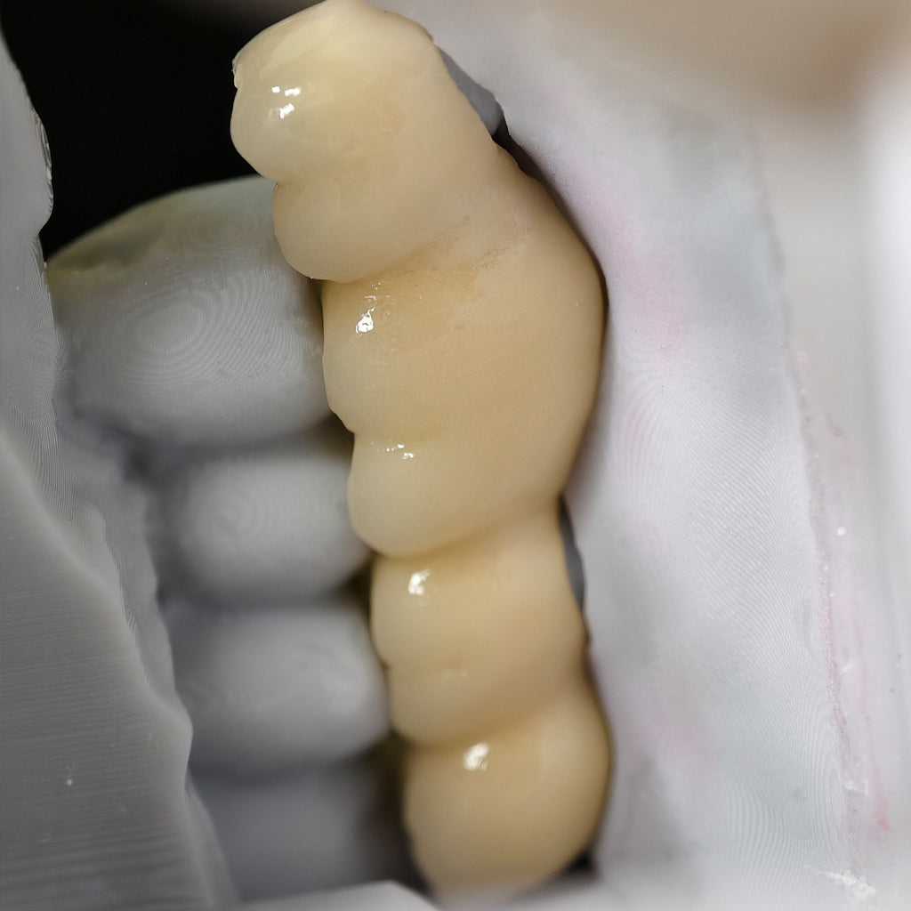 Co - Cr PFM Dental Bridge