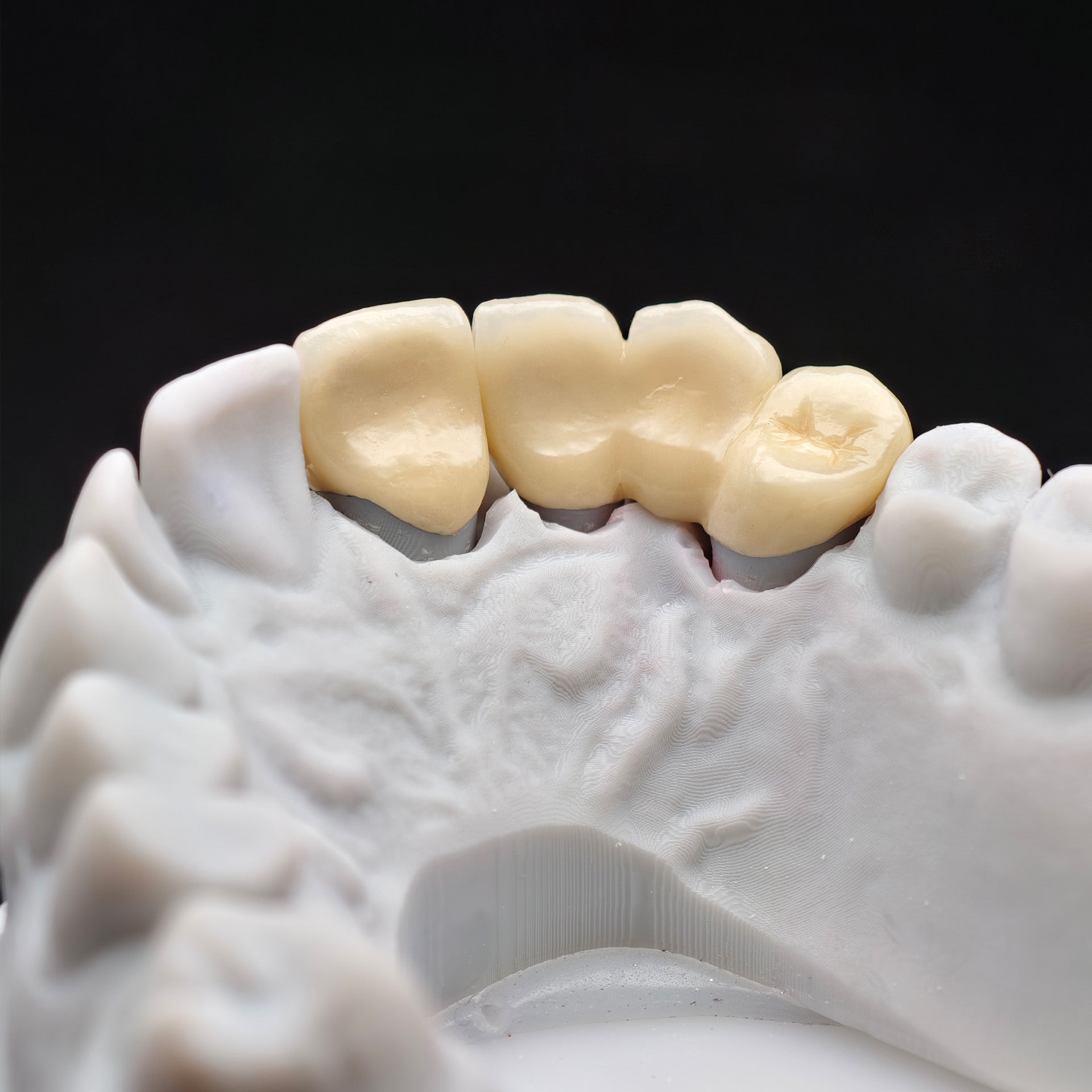 Co - Cr PFM Dental Bridge With Metal Post-And-Core