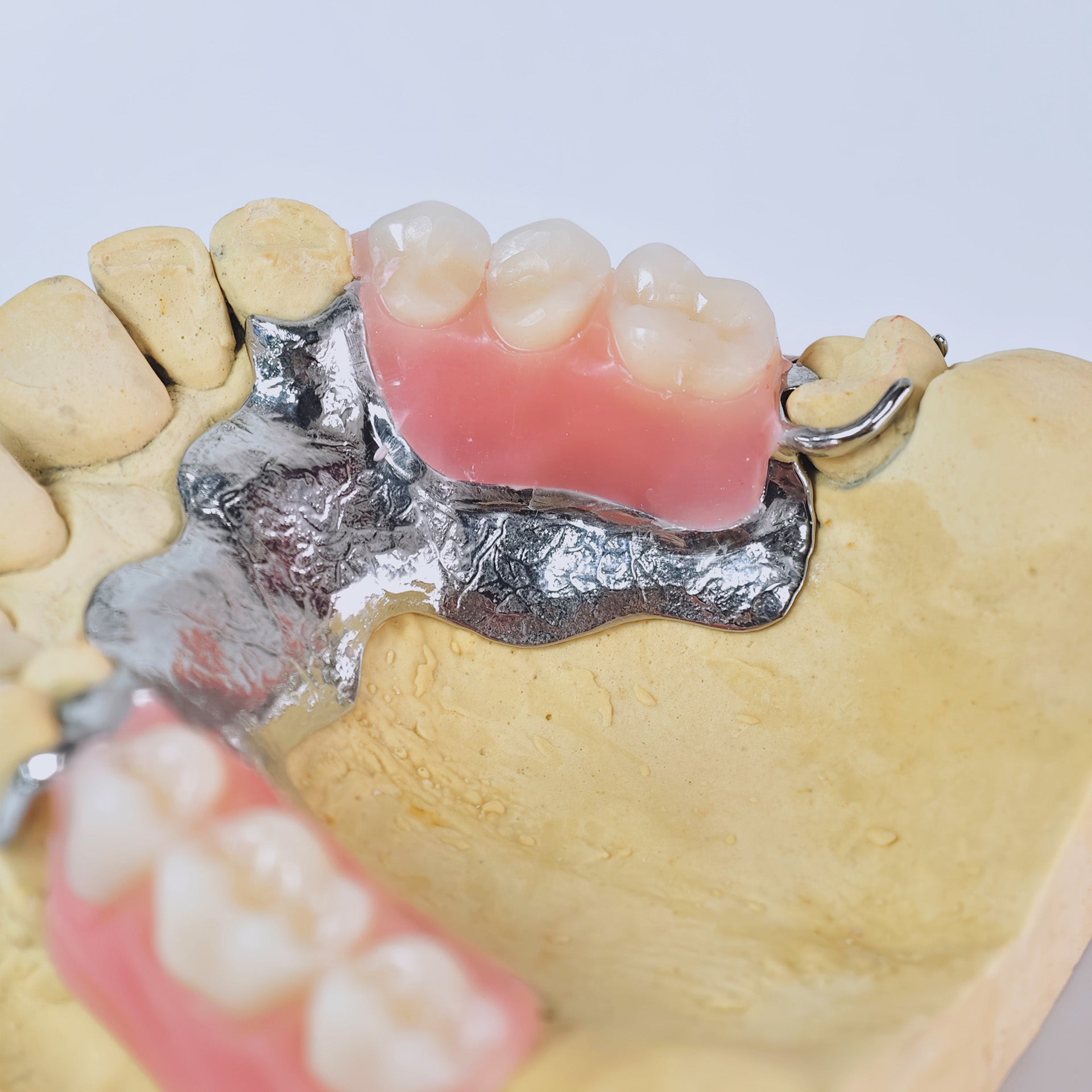 Cobalt Chrome Framework Denture Metal Framework With Acrylic Denture