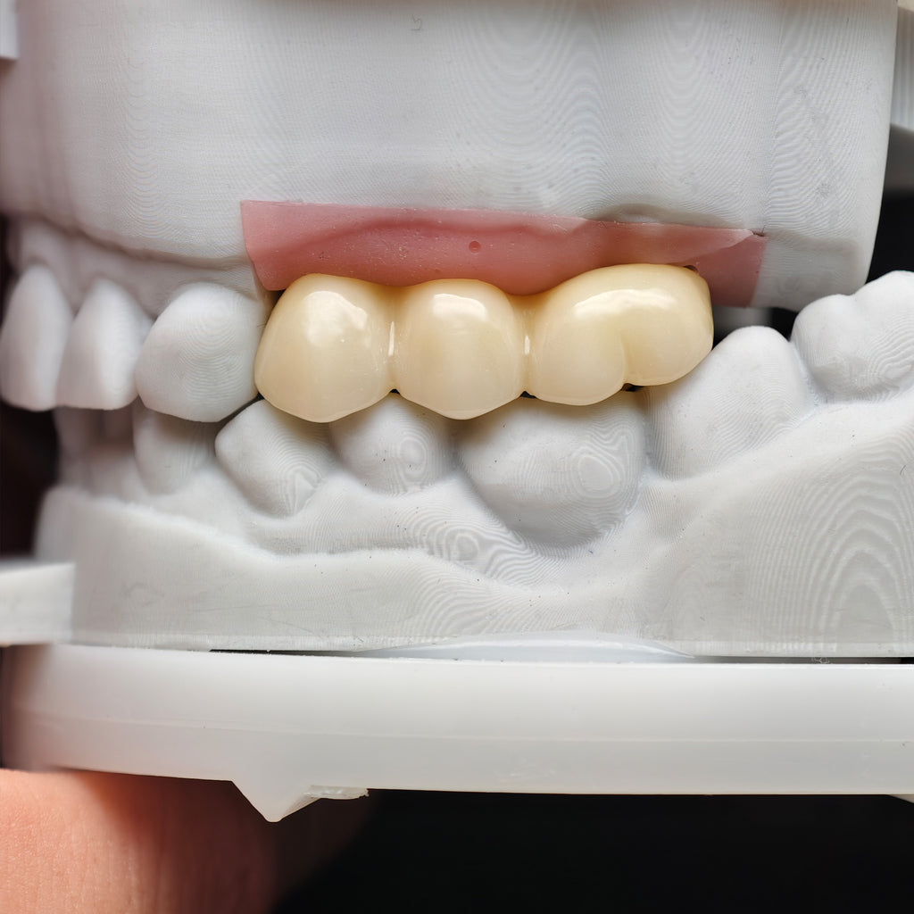 Custom Zirconia Implant Bridge