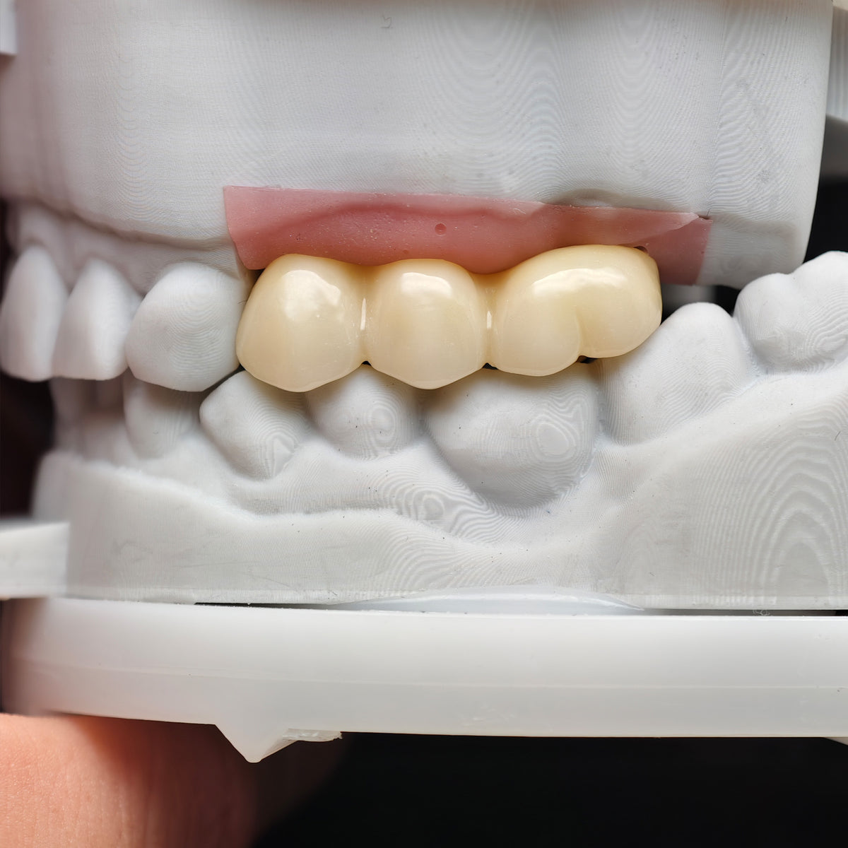 Custom Zirconia Implant Bridge
