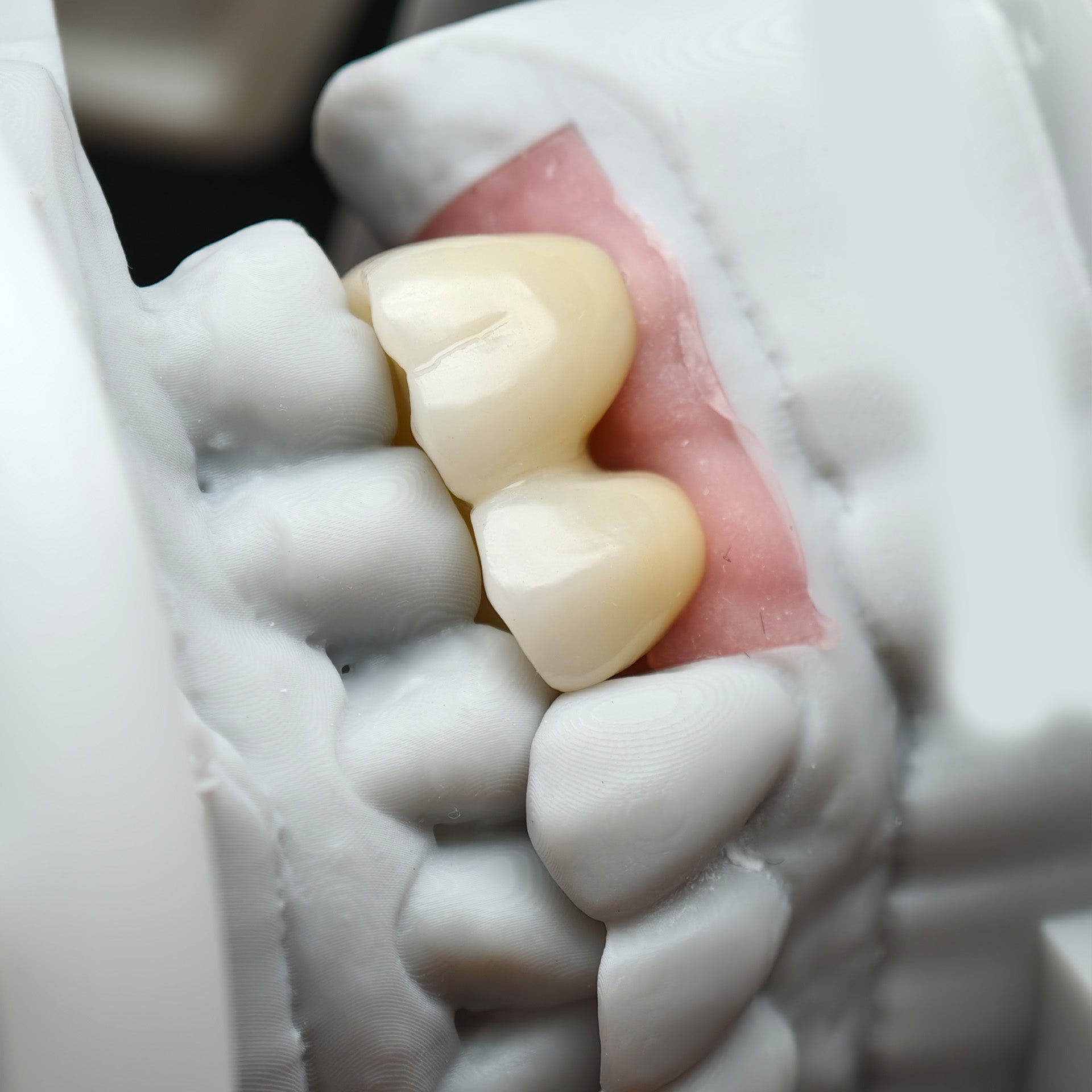Custom Zirconia Implant Bridge