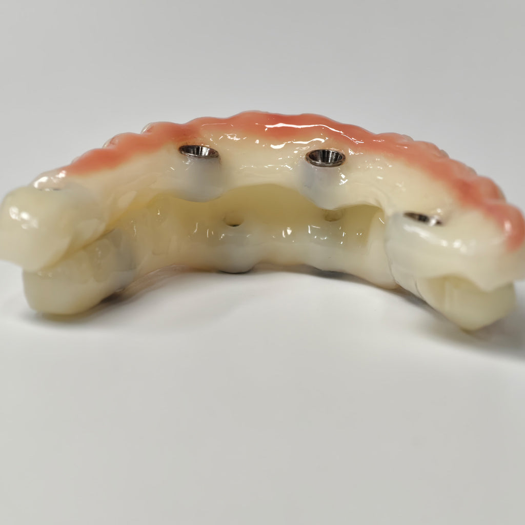 Full-Arch PMMA Bridge With Ti-Base Screw Retained
