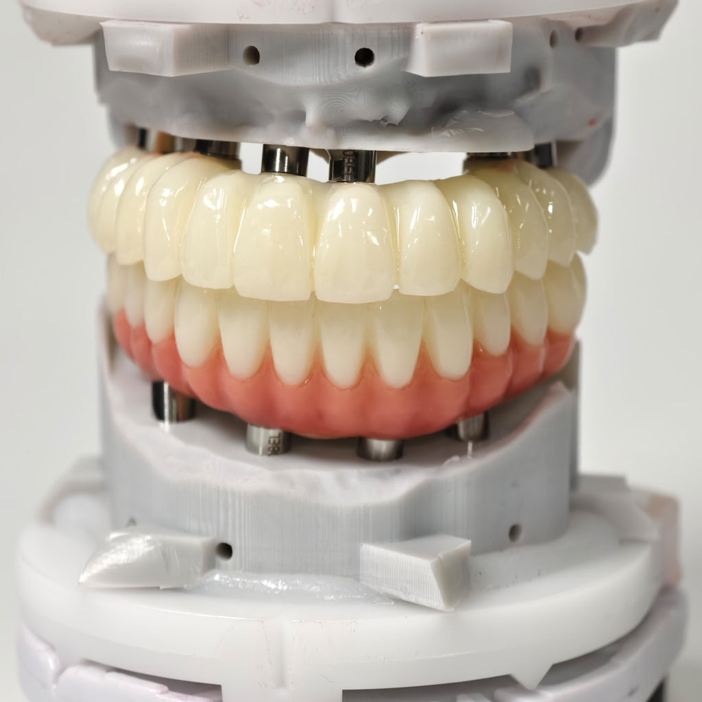 Full-Arch PMMA Bridge With Ti-Base Screw Retained