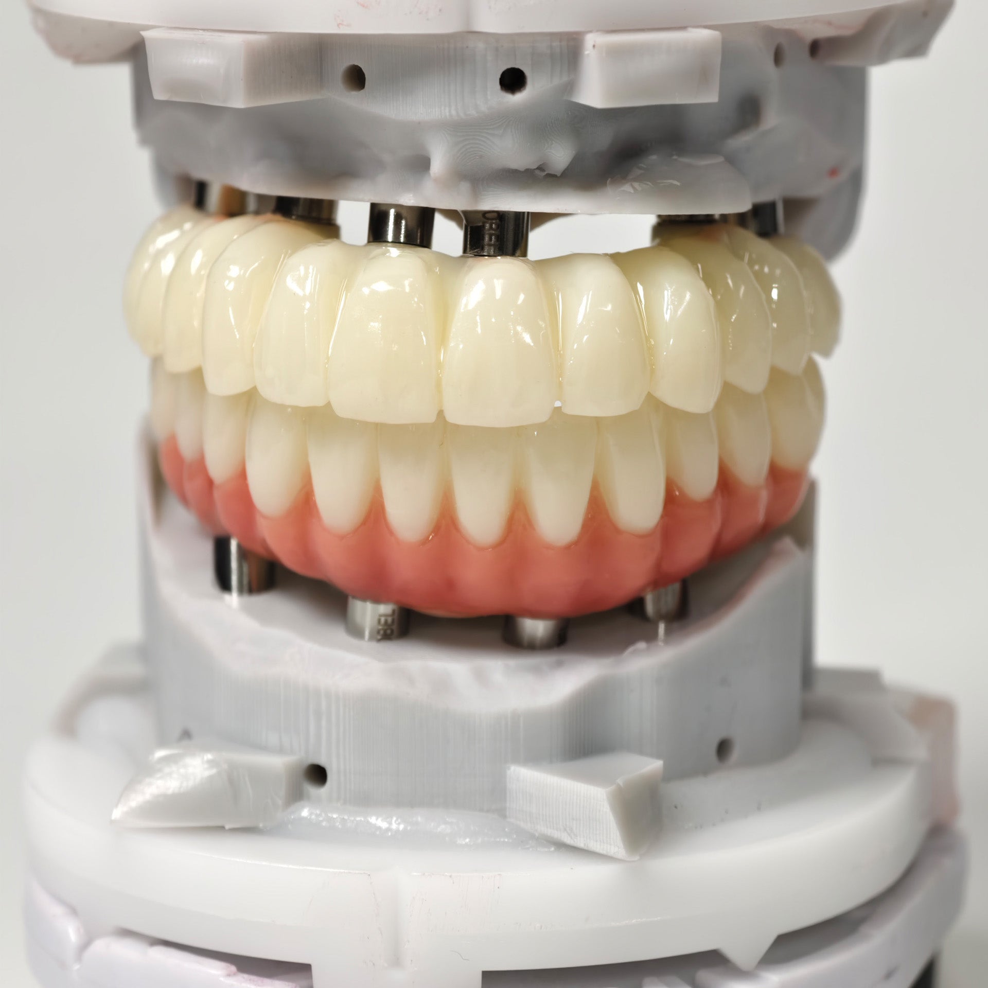Full-Arch PMMA Bridge With Ti-Base Screw Retained
