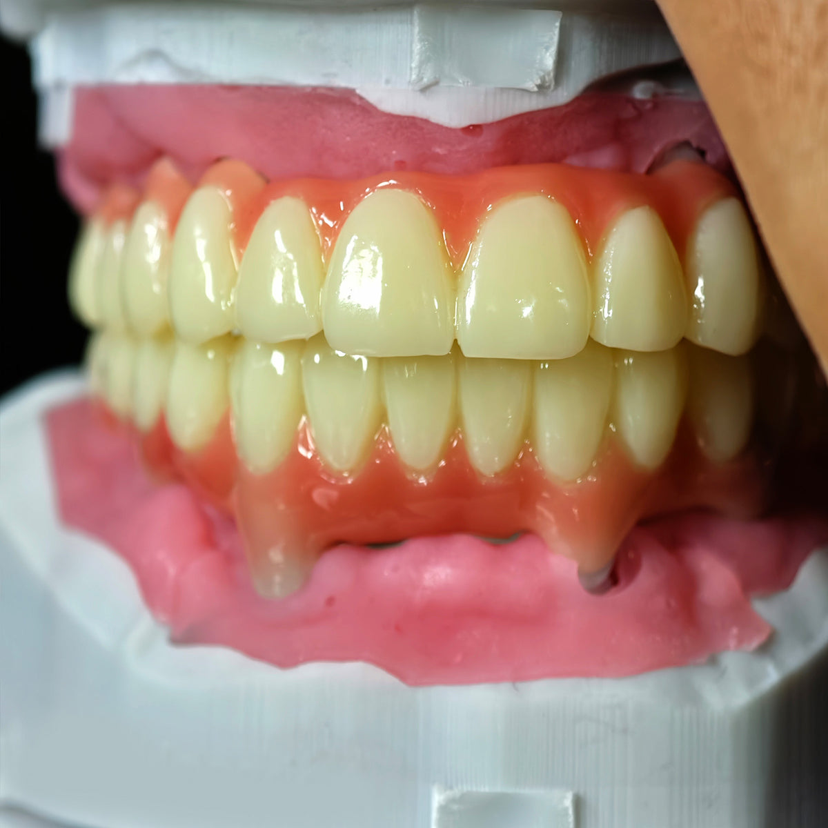 Full=Arch Pmma Bridge With Cement Retained