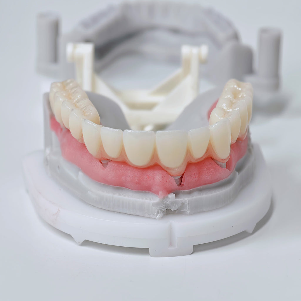 Half-Mouth Zirconia Bridge With Cement-Retained