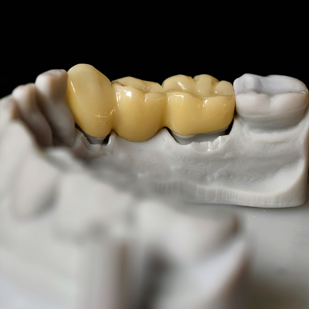 High - Strength Zirconia Bridge
