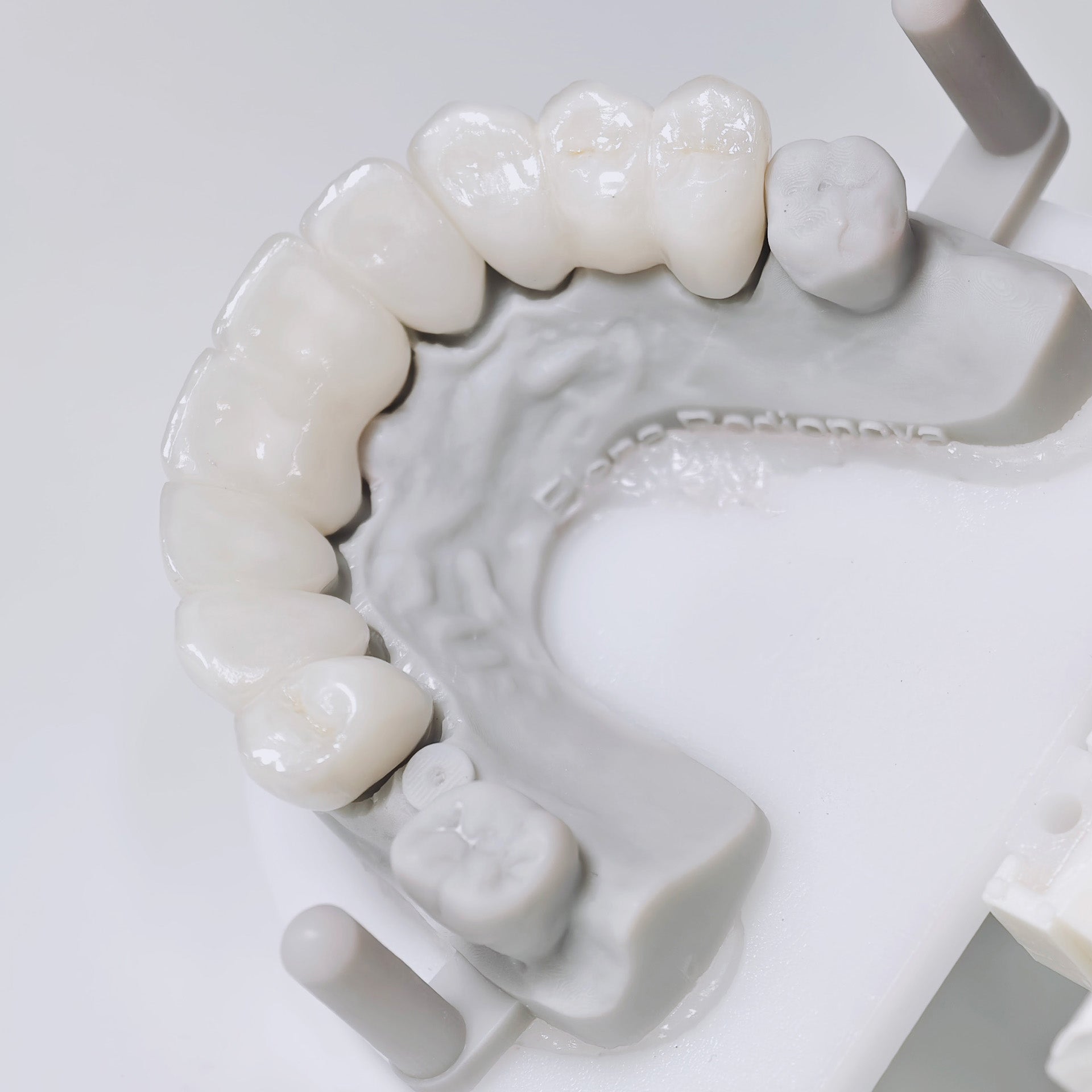 High - Strength Zirconia Bridge Aesthetic