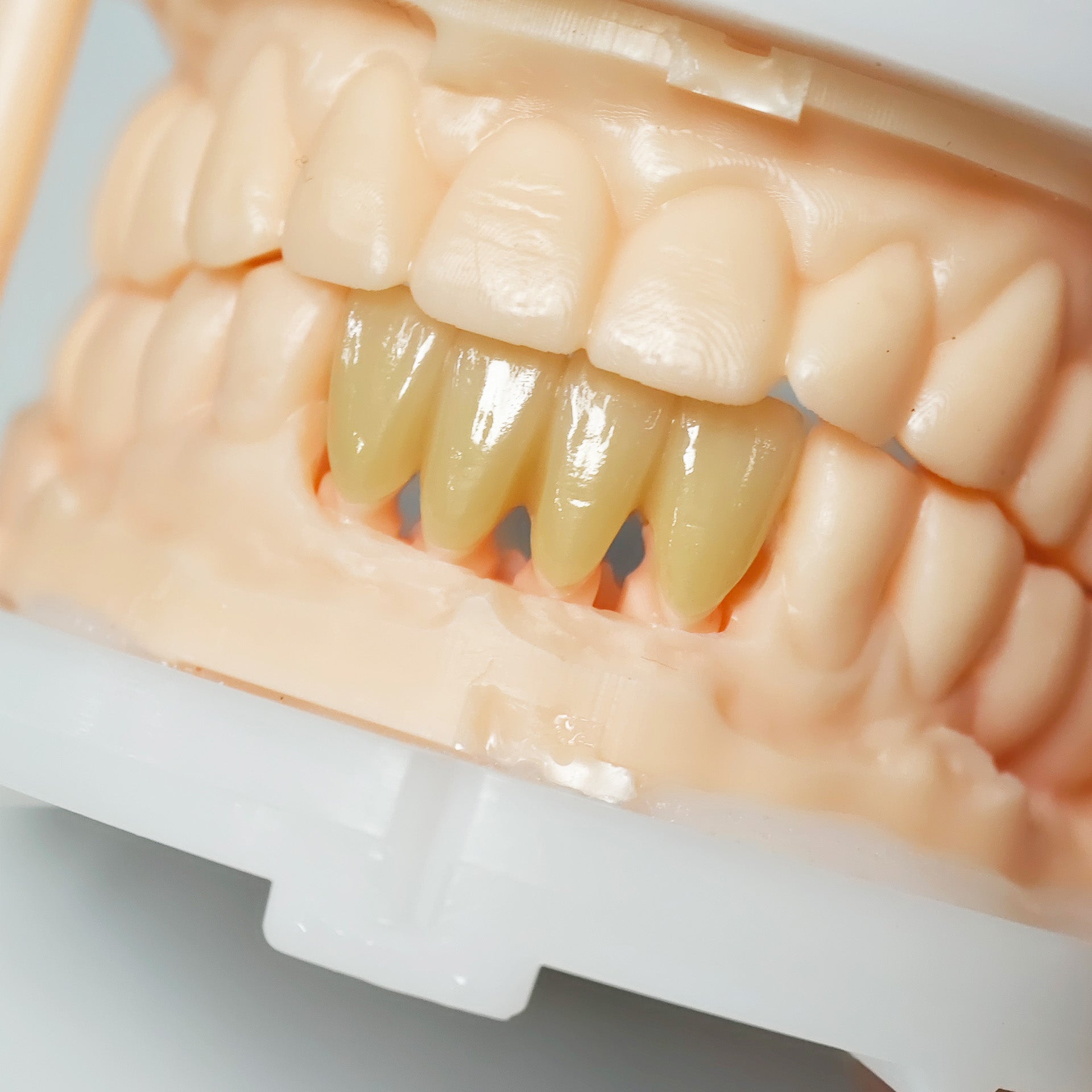 High - Strength Zirconia Bridge