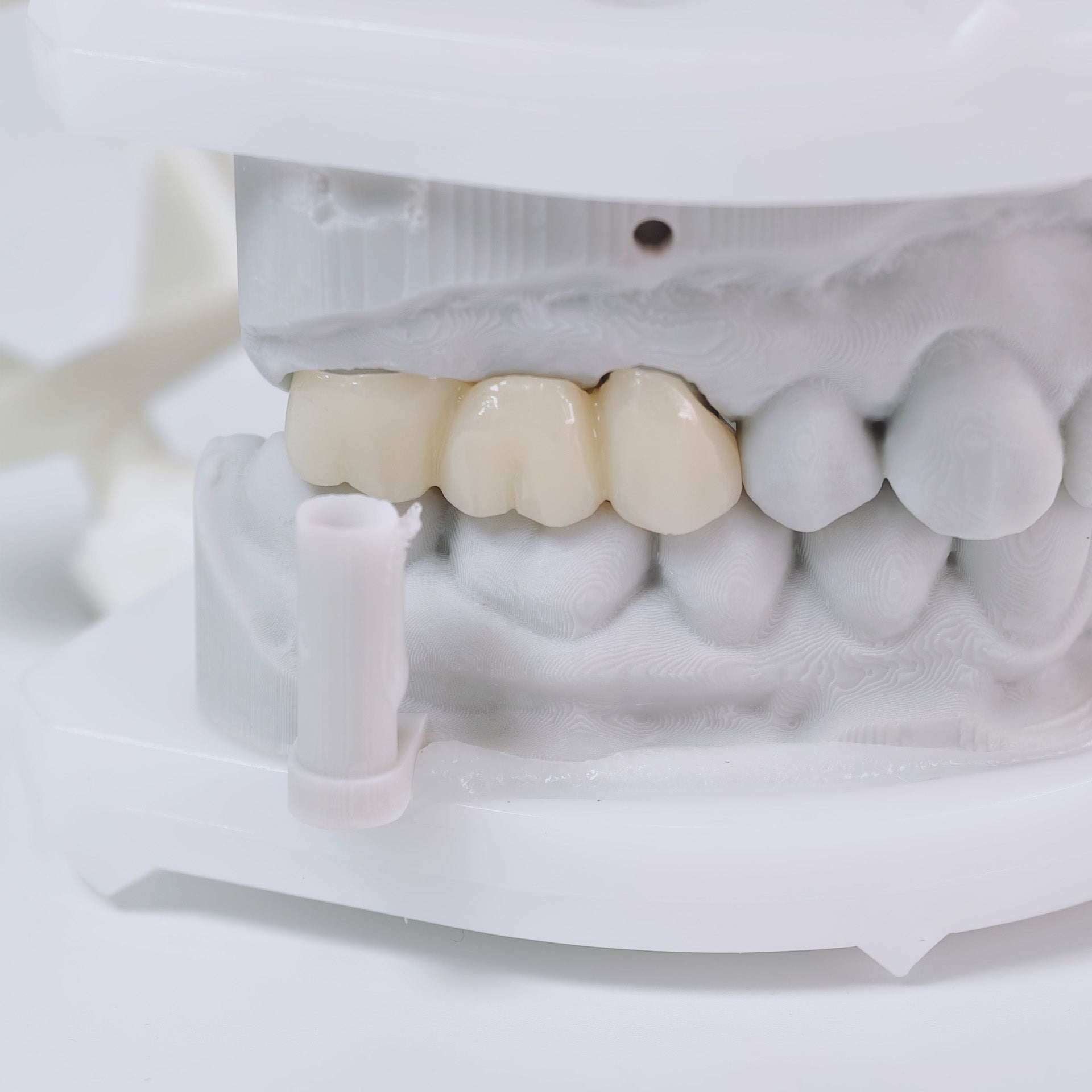 High - Strength Zirconia Bridge
