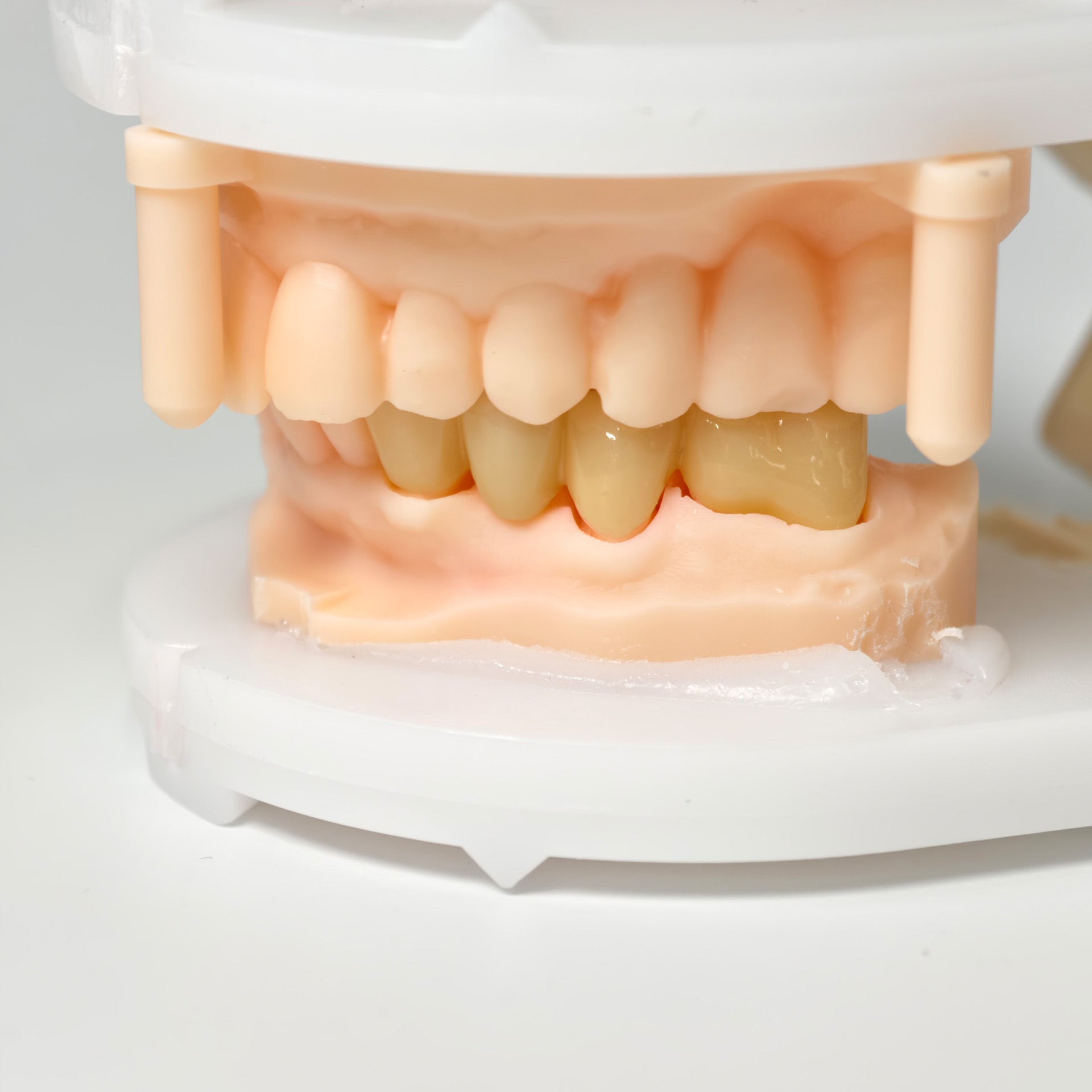 High - Strength Zirconia Bridge