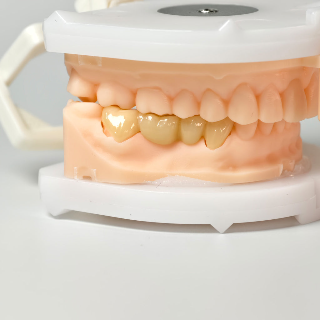 High - Strength Zirconia Bridge