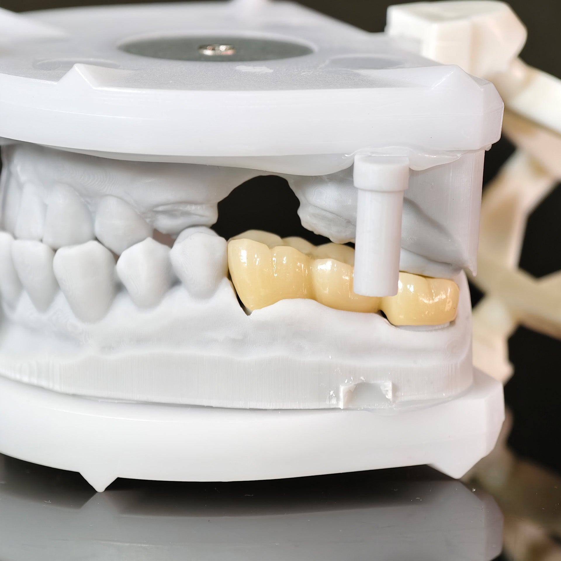High - Strength Zirconia Bridge