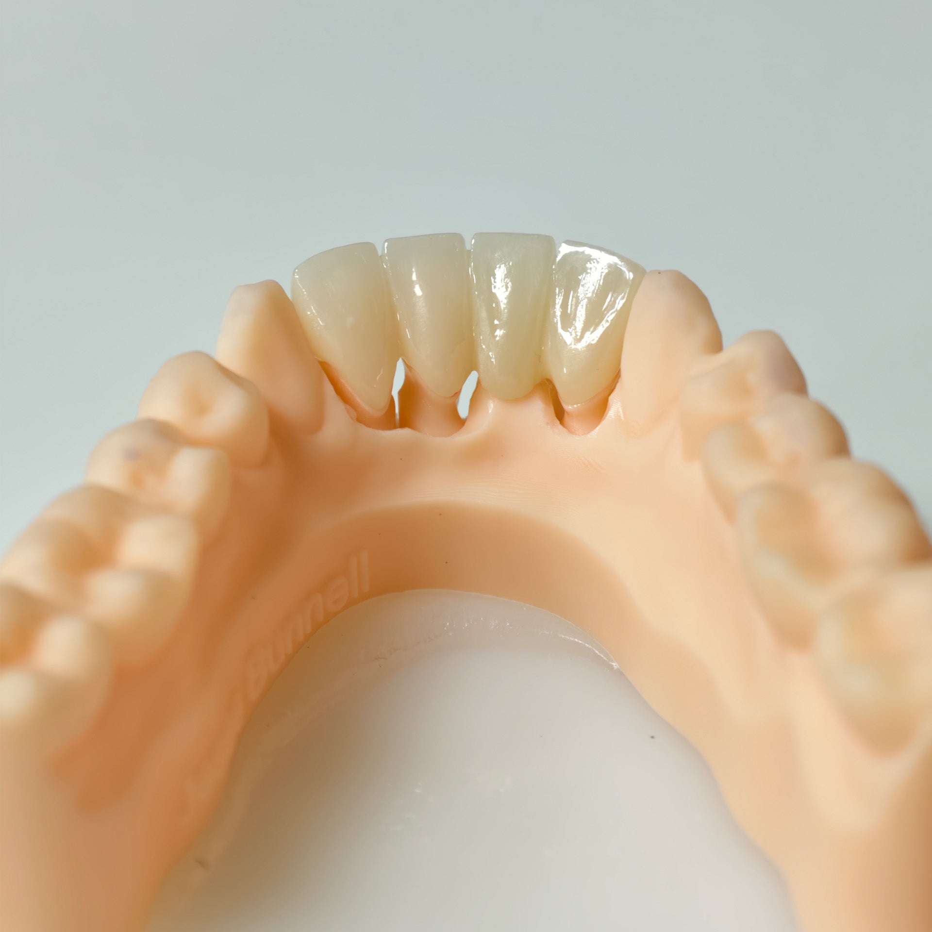 High - Strength Zirconia Bridge