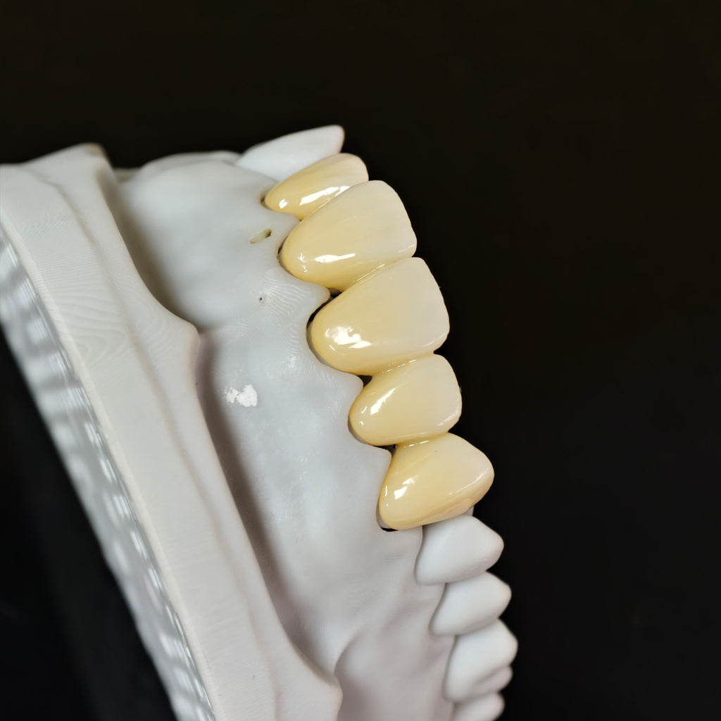 High - Strength Zirconia Bridge