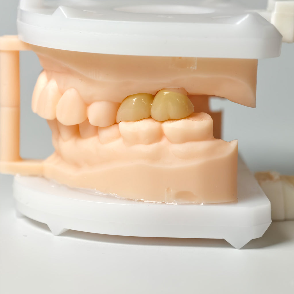High - Strength Zirconia Bridge