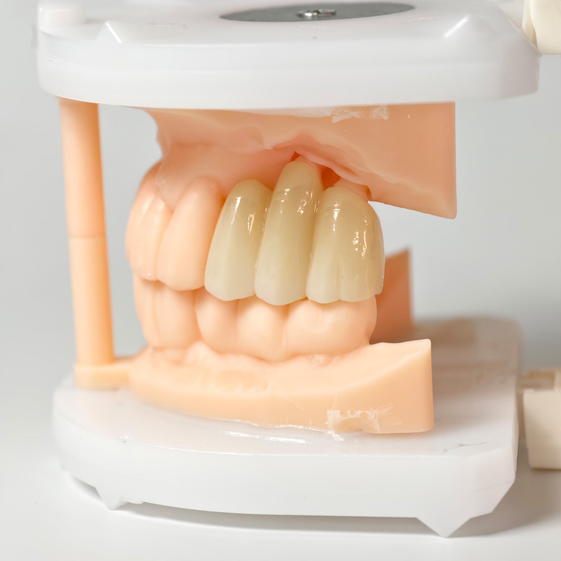 High - Strength Zirconia Bridge