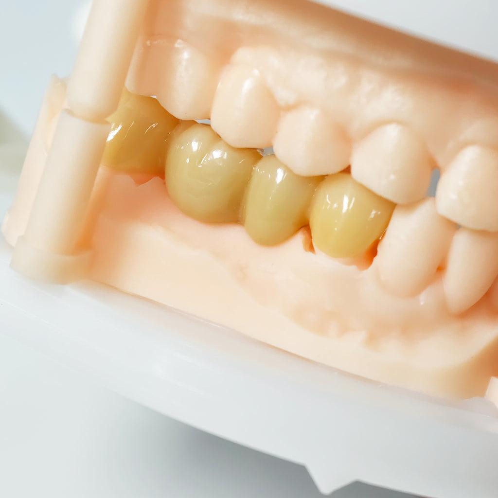 High - Strength Zirconia Bridge