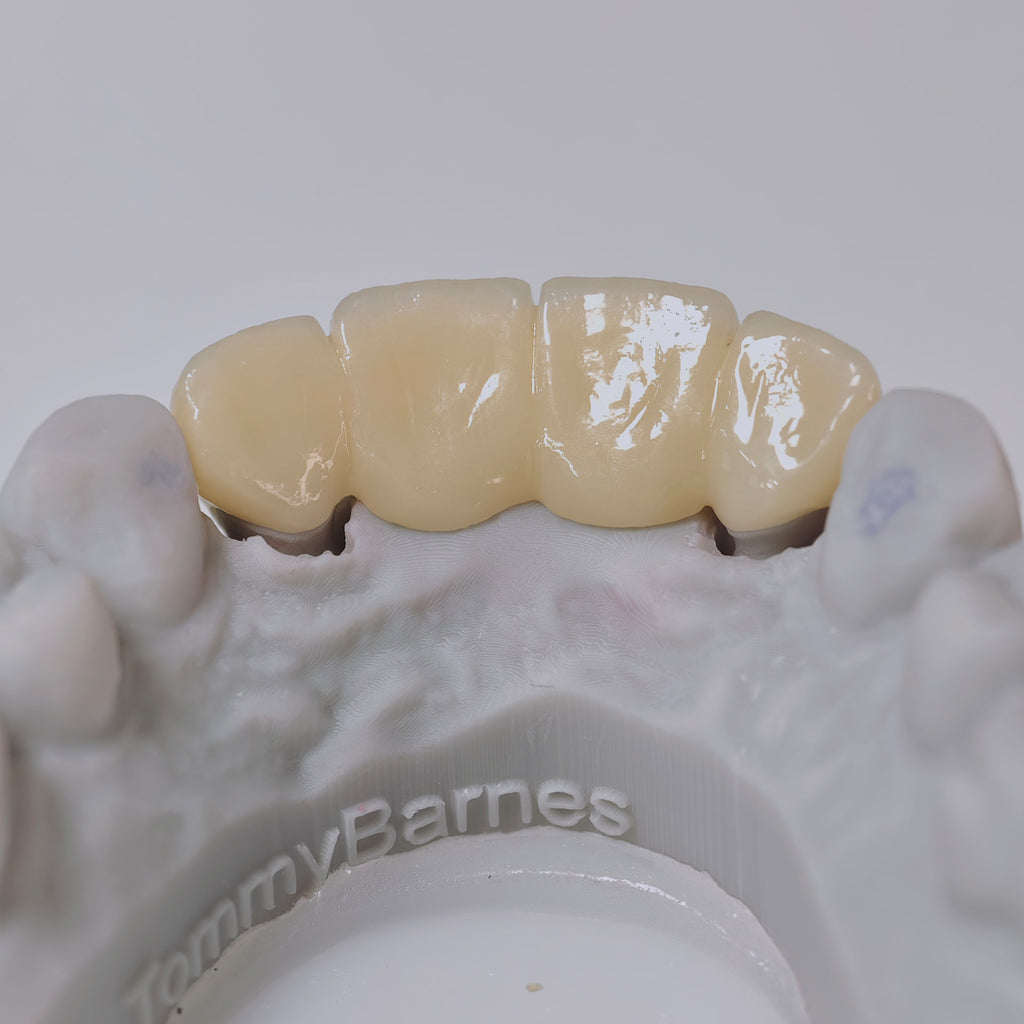 High - Strength Zirconia Bridge