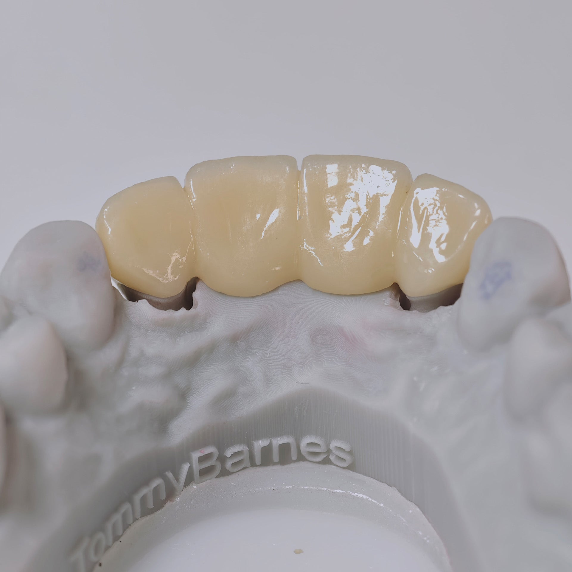 High - Strength Zirconia Bridge