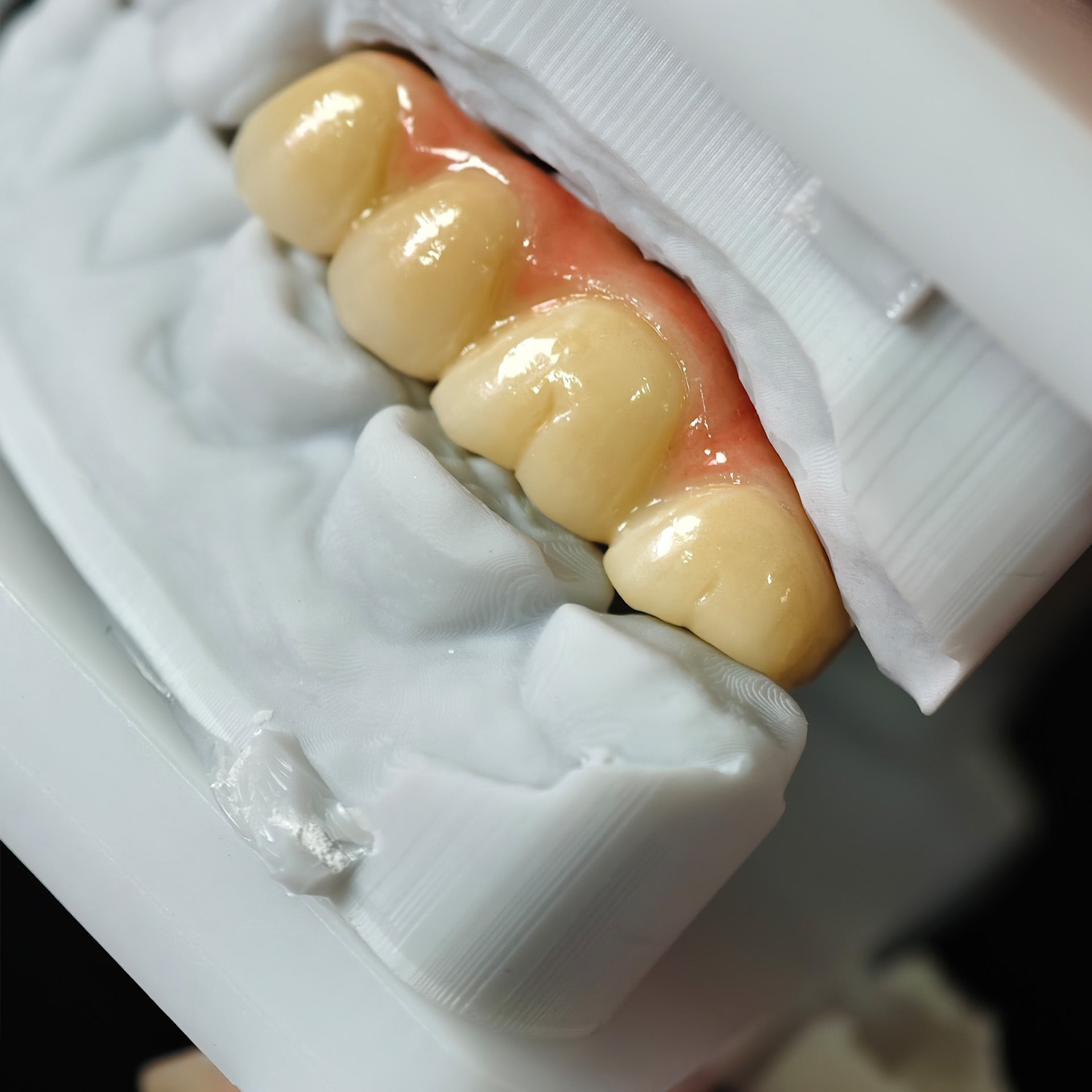High - Strength Zirconia Bridge