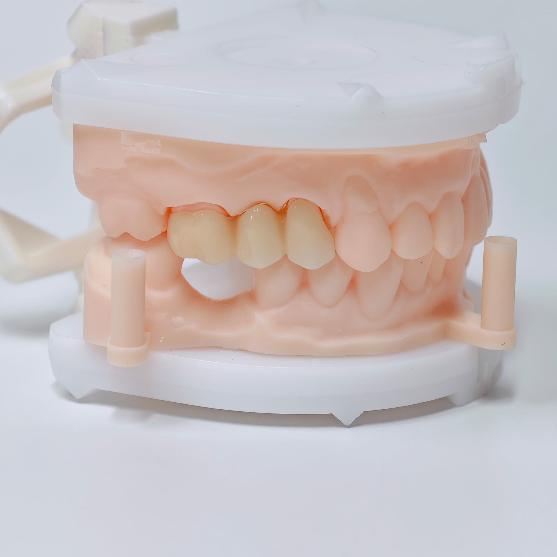 High - Strength Zirconia Bridge