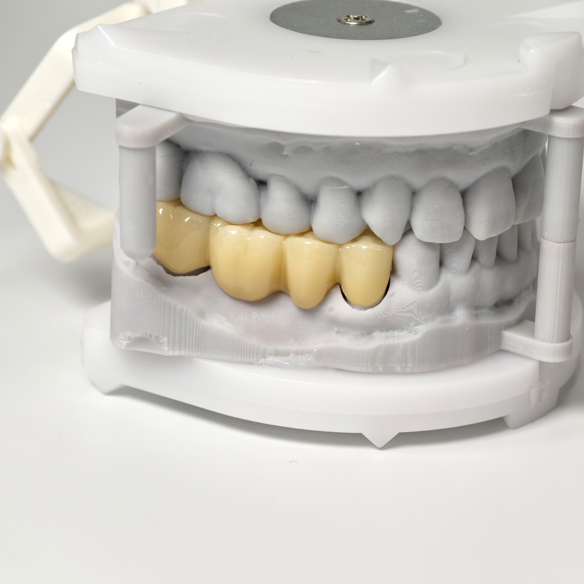 High - Strength Zirconia Bridge