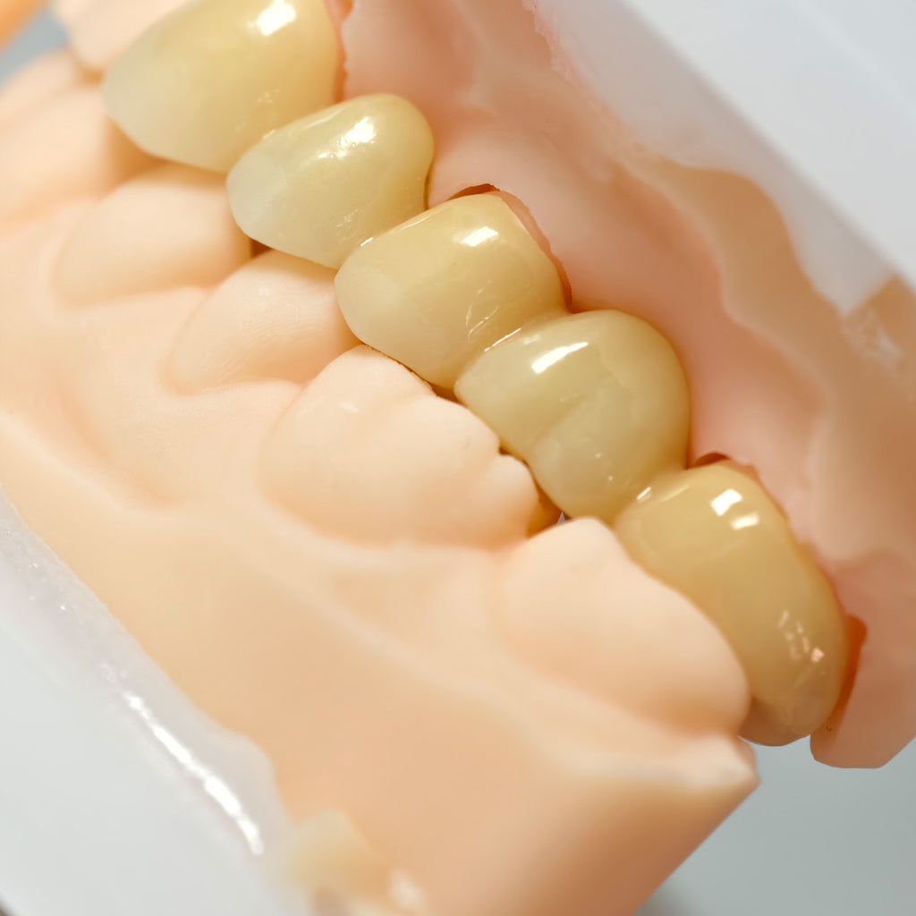 High - Strength Zirconia Bridge