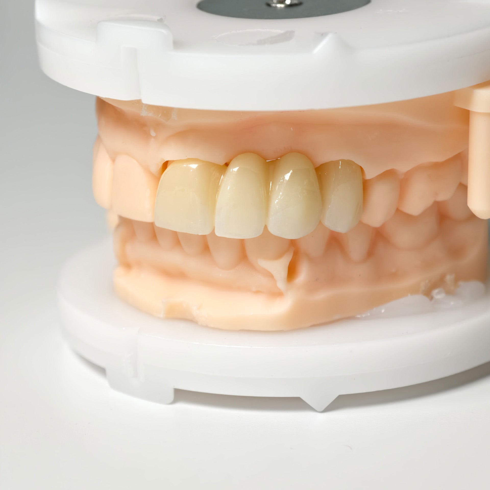 High - Strength Zirconia Bridge