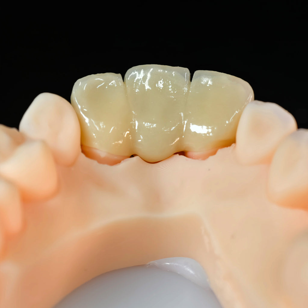 High - Strength Zirconia Bridge