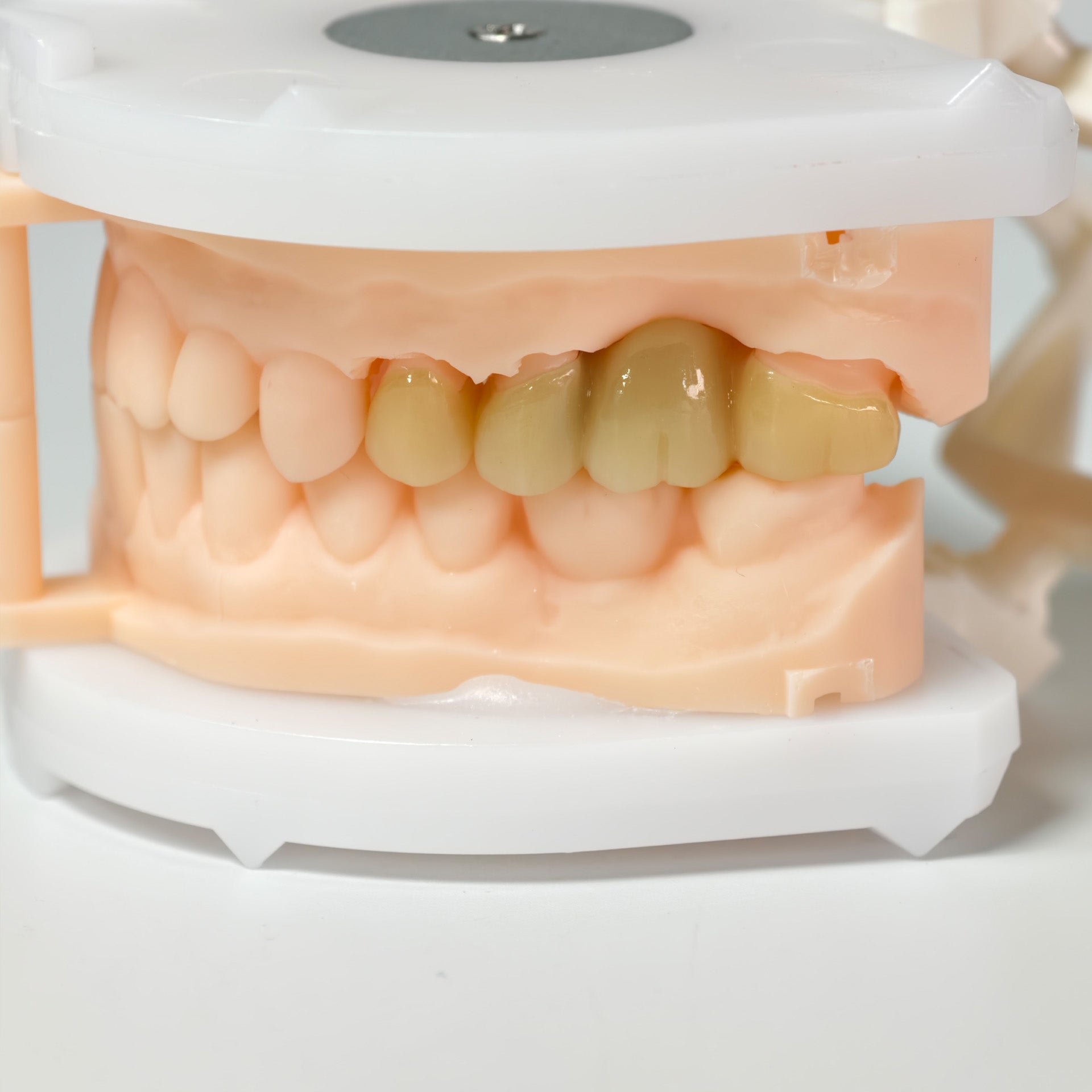 High - Strength Zirconia Bridge And Crown